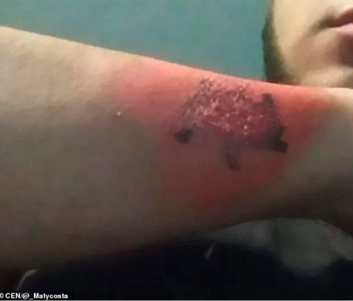 tetovažo, Neverjetno: Moški si je odstranil tetovažo s strgalom za sir