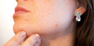 Acne Pores Skin Pimple Female  - Kjerstin_Michaela / Pixabay