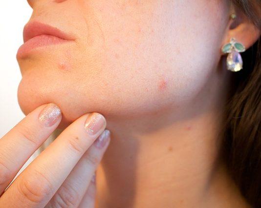 Acne Pores Skin Pimple Female  - Kjerstin_Michaela / Pixabay
